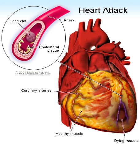 heart attack Understanding Heart Issue fatality - Child death Heart attack/stroke and astrological connection